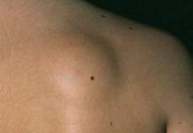 От чего появляются жировики: почему образуются и какая настоящая причина возникновения липом под кожей