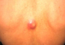 Жировик воспалился: что делать в домашних условиях и чем лечить, как выглядит воспаление на фото, почему воспаляется и болит, к какому врачу обращаться для лечения