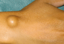 Жировик на руке: как выглядит на фото, причины появления и как избавиться, от чего появляются липомы под кожей, что делать если он болит и как его удалить