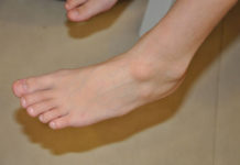 Жировик на ноге: как выглядит на фото, как убрать и избавиться от него, а также причины и лечение, что делать если липома болит и как происходит удаление