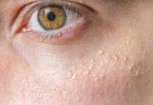 Белые жировики на лице: как избавиться и почему они появляются, можно ли убрать и удалить в домашних условиях, фото маленьких подкожных образований