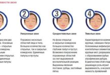 Степени тяжести акне и четыре стадии угревой болезни