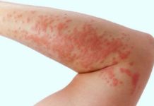 Сыпь уртикарная на коже: фото, причины, лечение