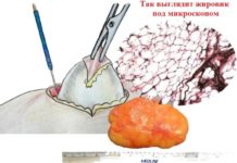 Хирургическое удаление липомы: подготовка, ход операции