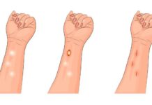 Удаление жировиков лазером: отзывы