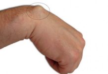 10 видов жировиков (липом) — мягкие, подкожные, воспалённые, фалькса