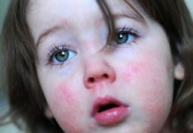 Псевдотуберкулез у детей: симптомы и лечение