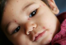 У ребенка прыщи на лице: виды высыпаний и способы лечения