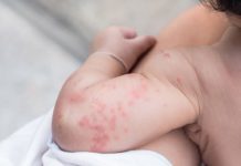 Прыщи у детей на руках: фото высыпаний, причины и лечение