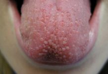 Гнойники на языке: фото, причины, симптомы, лечение, восстановительный период