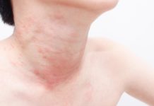 Сыпь на шее у взрослого: причины, возможные заболевания, методы лечения, отзывы