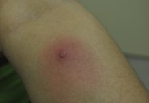 Фурункулез у ребенка: причины, методы лечения, последствия