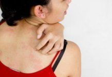 Крапивница после родов у кормящей мамы: клинические методы, симптомы, что делать и как лечить, от чего отказаться, народные рецепты, профилактика, осложнения