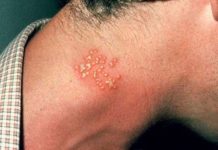 Пузырьковый лишай: причины возникновения, симптомы, диагностика, методы лечения