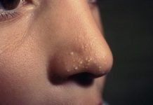 Жировики на носу: причины возникновения и особенности лечения