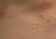 Чешется тело в разных местах