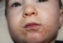 У ребенка сыпь на подбородке: причины, диагностика, лечение
