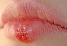 Болячка на губе: причины, лечение, а также чем помазать, чтобы быстро вылечить? |