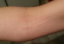 Сыпь при беременности — особенности, возможные причины и лечение