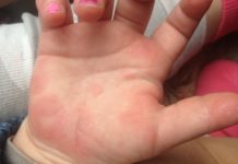 У ребенка чешутся ладошки: причины, методы диагностики, лечение