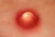 Фурункул в паху у мужчин: описание с фото, причины и методы лечения