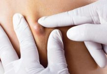 Жировики в паху у мужчин: причины, симптомы и методы лечения