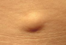 Выдавливание жировика — последствия