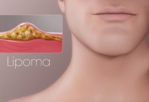 Что такое жировик и чем он опасен? Признаки и методы лечения