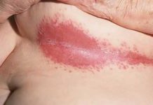 Фото высыпания на коже при диабете и средства для его лечения