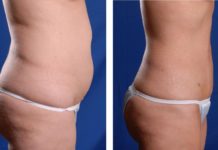 Как делают липосакцию живота и кому она нужна? Как делают липосакцию живота и кому она нужна?