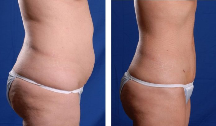 Как делают липосакцию живота и кому она нужна? Как делают липосакцию живота и кому она нужна?