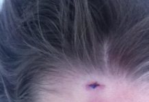 Отзыв о Удаление липомы | Как будто и небыло ничего!