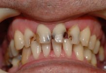 Гной на миндалинах (ФОТО): как лечить гной на гландах без температуры у ребенка