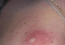 Самый большой прыщ в мире