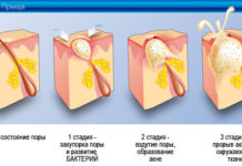 Елена Малышева о прыщах, угри излечимы | Чистая кожа без угрей