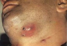 Удаление фурункула: как вскрывают в больнице и в домашних условиях, чем обрабатывать чирей |