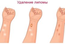 Удаление липомы: выбор и описание методов (хирургическим путём или лазером)