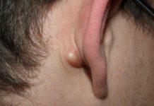 Жировик за ухом: фото, как избавиться от липомы на мочке уха, причины появления и лечение, а также удаление, как выглядит новообразование за ушами