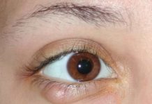 Жировики под глазами: как убрать и навсегда избавиться, причины и как их удалить, как выглядят белые жировики на фото и почему они появляются, можно ли выдавить