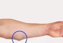 Операция по удалению липомы: лазерное удаление жировиков, хирургическое вмешательство, стоимость в Москве