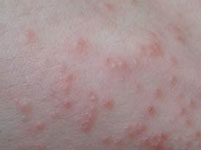 Красные прыщи по всему телу: причины и способы борьбы с неприятной проблемой |