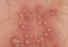 Сыпь на головке у мужчин: фото с пояснениями