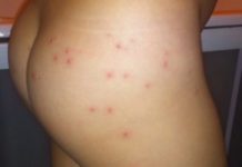 Чирей на попе: причины фурункула и как избавиться от него, если не проходит? |