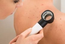 Жировик на спине — как выглядит опухоль, признаки, лечение народными средствами и операцией