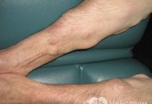 Липоматоз – лечение, липоматоз печени и кожи