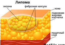 Липома: причины, диагностика и лечение
