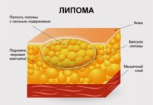Жировик на глазу и веках: как избавиться и почему появляется
