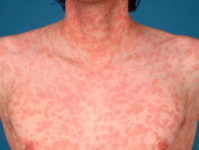 Сыпь при ВИЧ у мужчин и женщин: как выглядит на фото