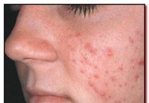 Как увлажнять проблемную кожу лица: пять правил | Чистая кожа без угрей