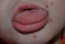 Белый прыщ на языке — у ребенка, взрослого, причины, болит что делать, как лечить, при беременности